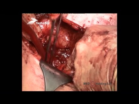 Operacja organooszczędzająca guza nerki jedynej