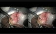 Podwójny skórzakotłuszczak spojówki- operacja za pomocą noża Fugo Plasma