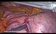 Chirurgiczne leczenie nowotworów podścieliskowych przewodu pokarmowego 