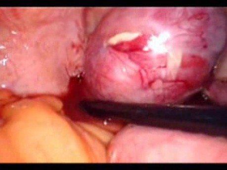 Perforacja okrężnicy z zapaleniem otrzewnej - laparoskopia (27 z 46)