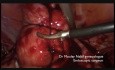 Bezkrwawa laparoskopowa miomektomia