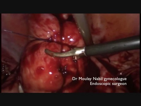Bezkrwawa laparoskopowa miomektomia