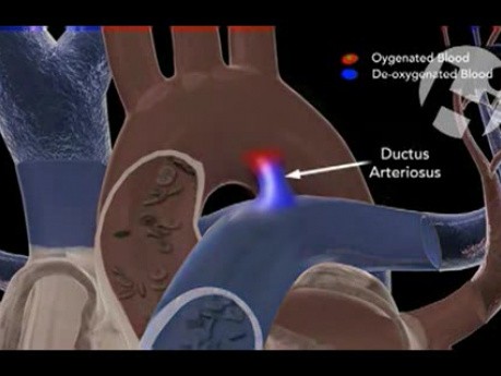 Ductus Arteriosus - przewód tętniczy Botalla
