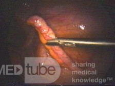 Ropowicze zapalenie wyrostka robaczkowego- zdjęcie śródoperacyjne