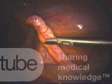 Ropowicze zapalenie wyrostka robaczkowego- zdjęcie śródoperacyjne