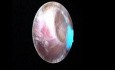 Histeroskopowa ablacja endometrium z mini resektorem