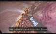 Laparoskopowa lewostronna resekcja wątroby