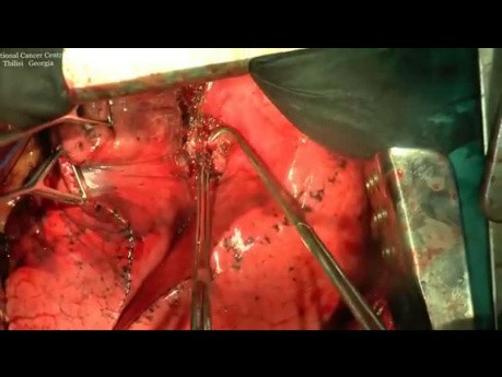 Lobektomia górna lewa metodą otwartą u pacjenta z powikłaniami
