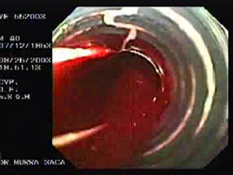 Ostre krwawienie z żylaków - krew dostająca się do aparatu opaskującego, część 2