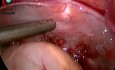 Czy laparoskopia może pełnić rolę w urazach?