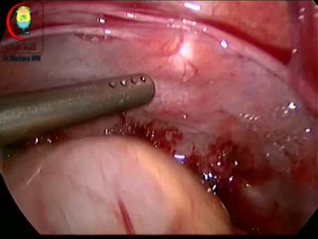 Czy laparoskopia może pełnić rolę w urazach?