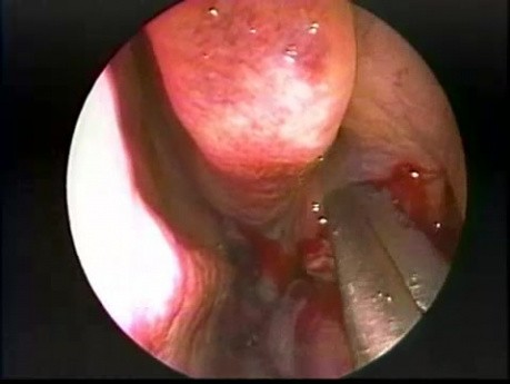 Endoskopowe zaopatrzenie hipoplastycznej zatoki szczękowej (typu II)