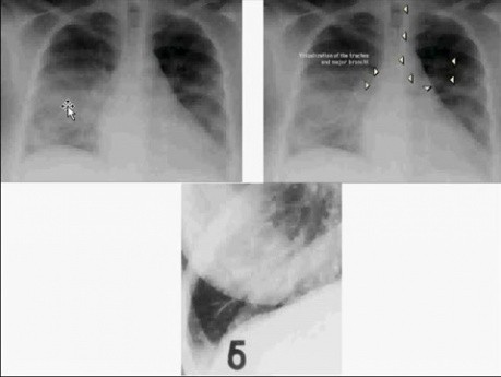 Zaburzenia hemodynamiczne, choroba zakrzepowo-zatorowa i wstrząsy - patomorfologia - część 4c