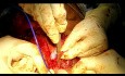 Założenie protezy tchawiczo-przełykowej po laryngektomii