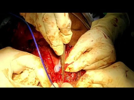 Założenie protezy tchawiczo-przełykowej po laryngektomii