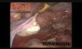 Usunięcie guzków zlokalizowanych w przegrodzie odbytniczo-pochwowej z całkowitą laparoskopową histerektomią