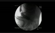 Kolonoskopia: endoskopowe leczenie niedrożności okrężnicy - poszerzanie miejsca zwężenia