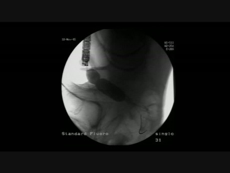 Kolonoskopia: endoskopowe leczenie niedrożności okrężnicy - poszerzanie miejsca zwężenia