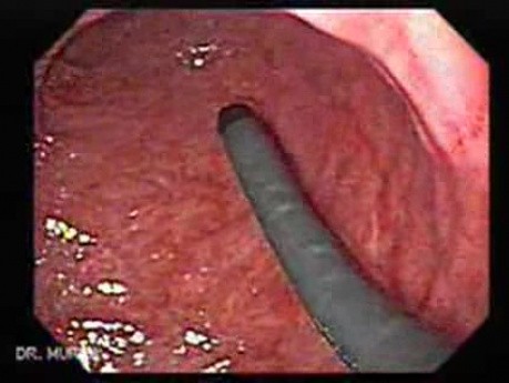 Przełyk Barretta i gruczolakorak połączenia żołądkowo-przełykowego - wprowadzenie dwóch endoskopów