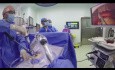 Wideotorakoskopowa lobektomia z jednego cięcia bez asysty