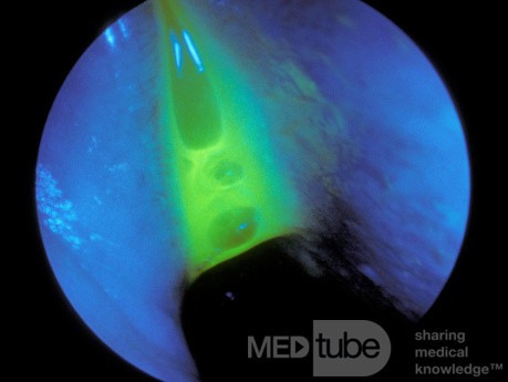 Test fluoroscencyjny na obecność wycieku PMR z nosa