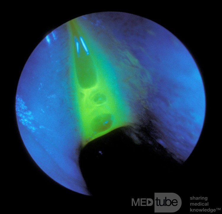 Test fluoroscencyjny na obecność wycieku PMR z nosa