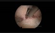 Histeroskopia- macica z przegrodą częściową