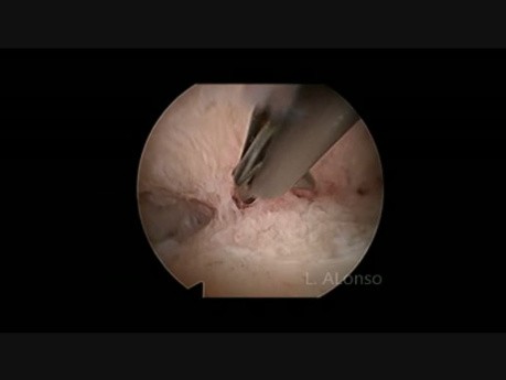 Histeroskopia- macica z przegrodą częściową