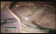 18-centymetrowy mięśniak zlokalizowany w więzadle szerokim macicy wrastający w cieśń
