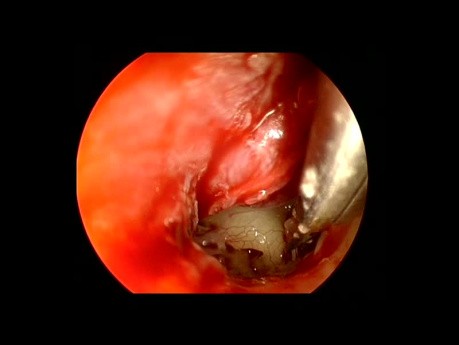 Endoskopowa stapedotomia