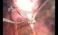 Całkowita histerektomia laparoskopowa z obustronnym usunięciem przydatków