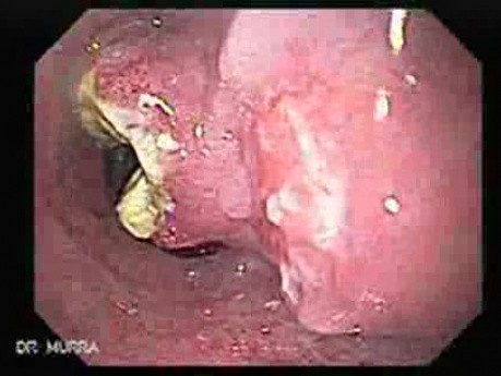 Drobnokomórkowy rak płuc atakuje górną i środkową część przełyku - obraz środkowej części przełyku