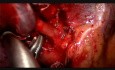 Pierwsza wideotorakoskopowa lobektomia bez intubacji w Wielkiej Brytanii