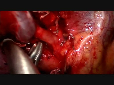 Pierwsza wideotorakoskopowa lobektomia bez intubacji w Wielkiej Brytanii