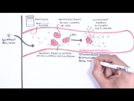 Nadwrażliwość typu II (reakcja cytotoksyczna) - przyczyny, patofizjologia, układ dopełniacza
