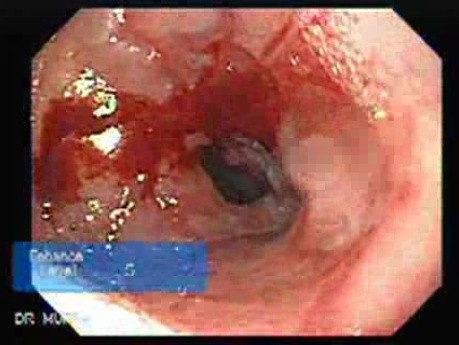 Pneumatyczna dylatacja przełyku - endoskopowa ocena dolnej części