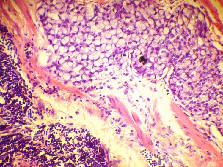 Obraz endoskopowy raka włóknistego żołądka obejmującego dno, trzon i część przedodźwiernikową (45 z 47)