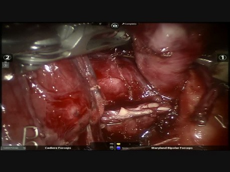 Rak gruczołowy płuca po terapii neoadiuwantowej - lobektomia płata środkowego w asyście robota