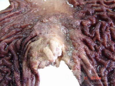 Gruczolakorak wpustu i dna żołądka z komórkami sygnetowatymi (16 z 25)