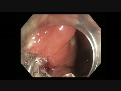 Kolonoskopia - klipsowanie ubytku po EMR
