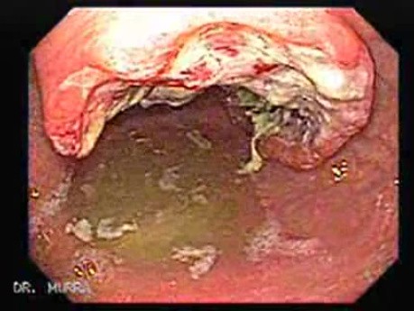 Rak gruczołowy trzonu i jamy odźwiernikowej (4 z 5)