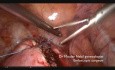 Miomektomia laparoskopowa