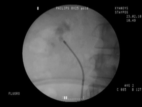 RIRS (Nefrolitotrypsja giętka): Kamień zlokalizowany w biegunie dolnym