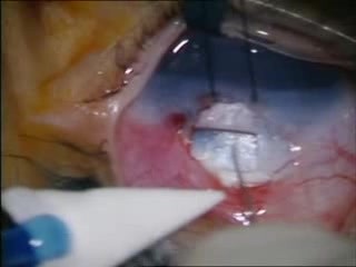 Trabekulektomia - operacja jaskry