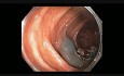Endoskopowa resekcja śluzówkowa dużego polipa w poprzecznicy u pacjenta z polipowatością gruczolakowatą jelita grubego związaną z MYH
