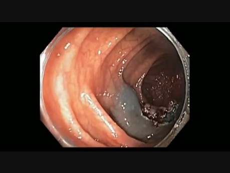 Endoskopowa resekcja śluzówkowa dużego polipa w poprzecznicy u pacjenta z polipowatością gruczolakowatą jelita grubego związaną z MYH