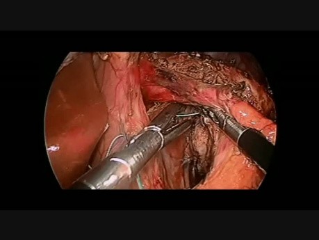 Laparoskopowa kardiomiotomia wg Hellera powikłana perforacją śluzówki przełyku