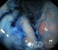 Nietypowy obraz polipów dna i trzonu żołądka w endoskopii. Chromoendoskopia. NET (6/6)