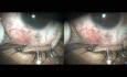 Buphthalmos, Failed Surgery, 4th Operation