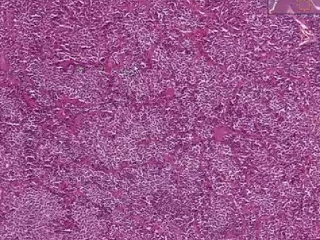 Acidophilic adenoma - Histopatologia przysadki